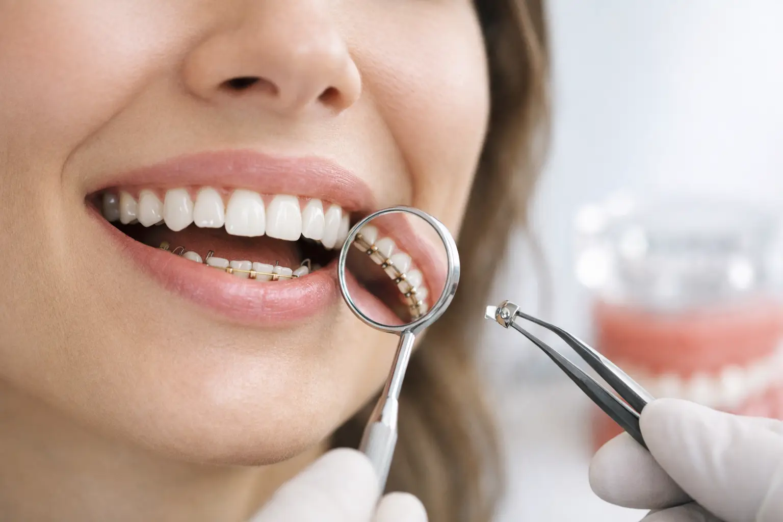 Orthodontie linguale : discrétion et précision